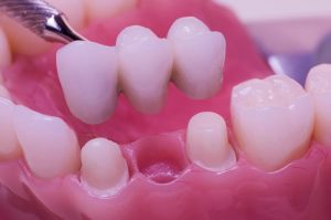 Dental bridges at Turners Falls Dental in Turners Falls, MA