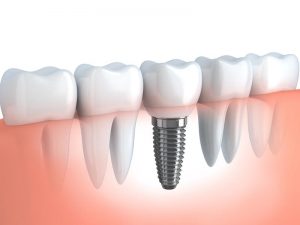 Dentist serving Montague MA patients at Turners Falls Dental