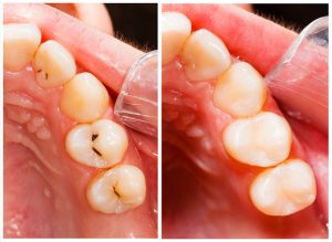 Tooth-colored composite fillings at Turners Falls Dental in Turners Falls, MA