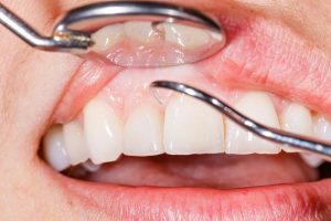 Bad breath halitosis treatment at Turners Falls Dental in Turners Falls, MA