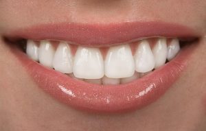 Dental sealants for children at Turners Falls Dental in Turners Falls, MA