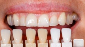 Porcelain veneers at Turners Falls Dental in Turners Falls, MA